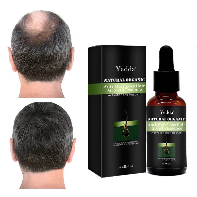 Own Brand Vegan Organic Biotin Nourishing Anti-dandruff Scalp Oil-Hair Oil Preventing Hair Loss & Promoting Growth 30ml